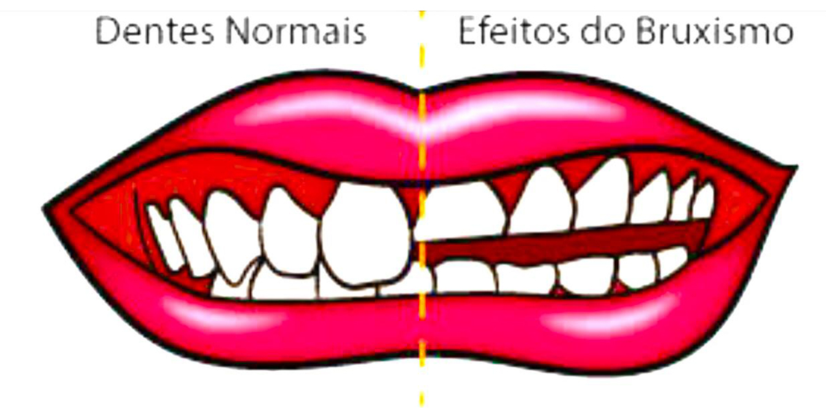 Tratamento para Bruxismo 